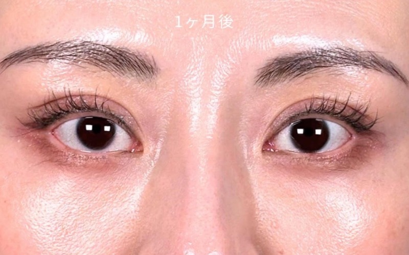 目の下の膨らみとり 施術後