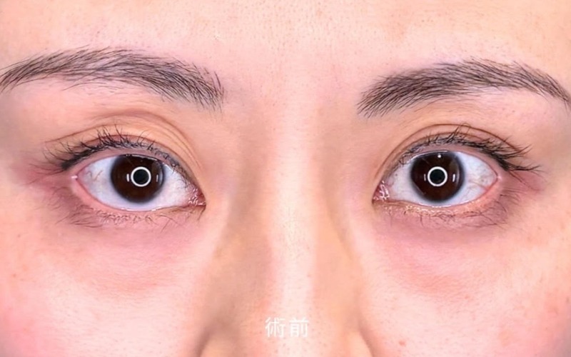 目の下の膨らみとり 施術前