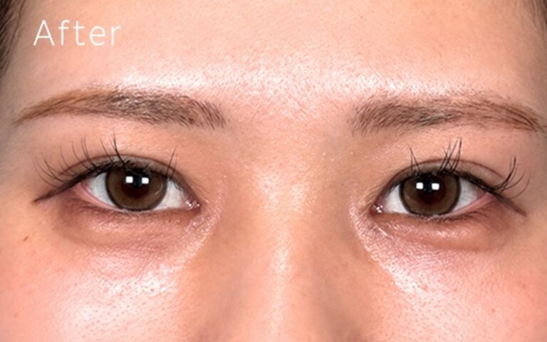 目頭切開 施術後