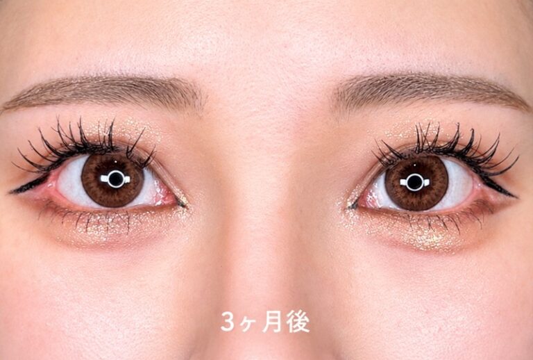 目頭切開、目尻切開 施術後