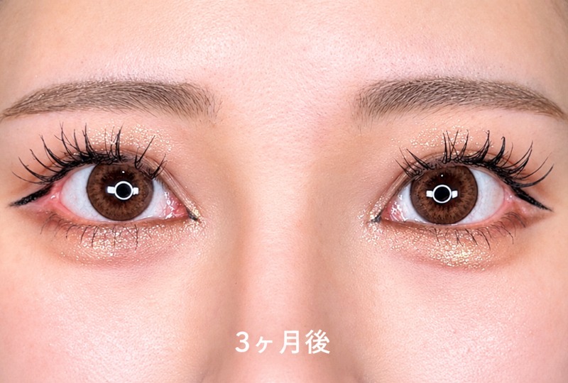 目頭切開、目尻切開 施術後