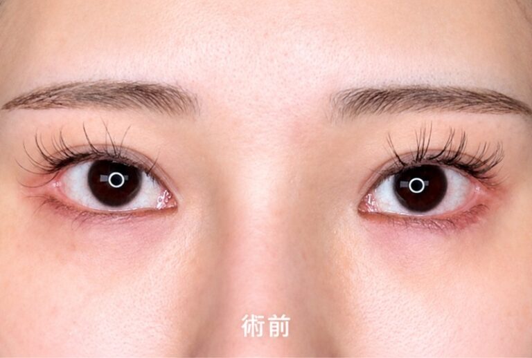 目頭切開、目尻切開 施術前