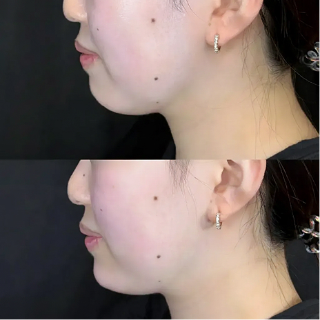 顎ヒアルロン酸注入