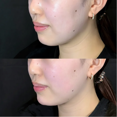 顎ヒアルロン酸注入2