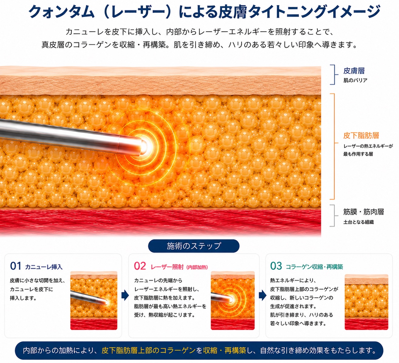 高周波で皮膚深部を加熱し内側から引き締めるクォンタムRF｜大阪・豊中 Wing clinic