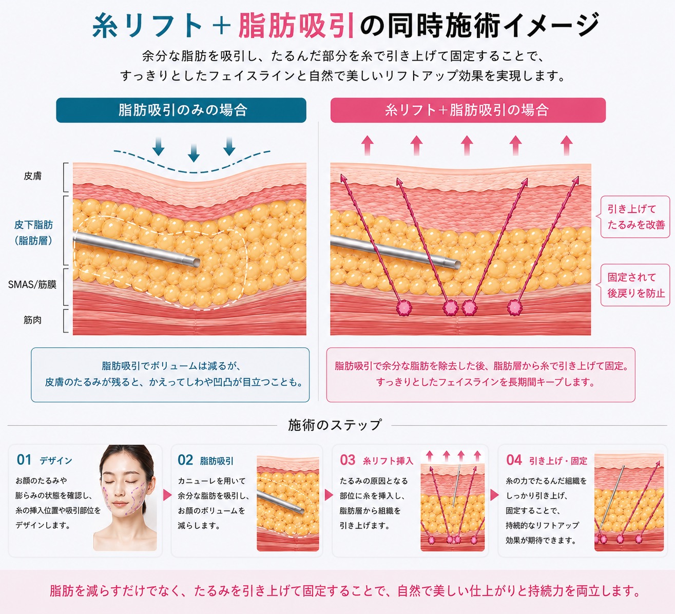 糸リフト＋脂肪吸引の同時施術イメージ — 余分な脂肪を吸引し糸で引き上げ固定｜大阪・豊中 Wing clinic