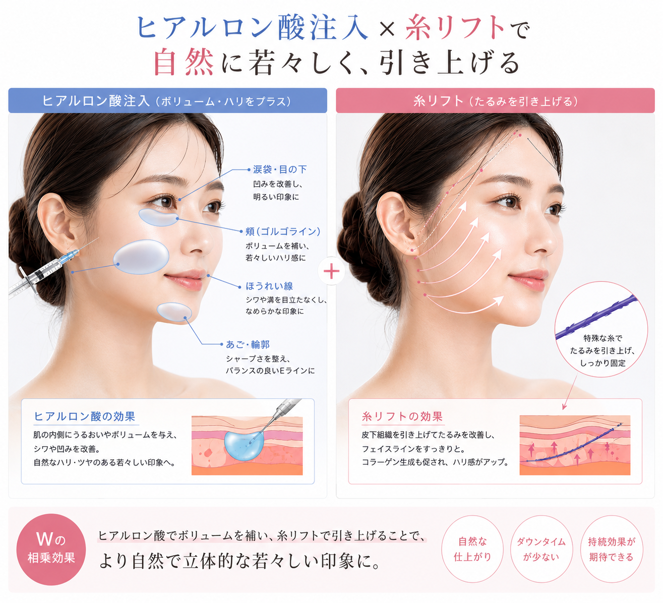 ヒアルロン酸注入×糸リフトの併用効果の解説図 — ボリューム補正と引き上げのW効果｜大阪・豊中 Wing clinic