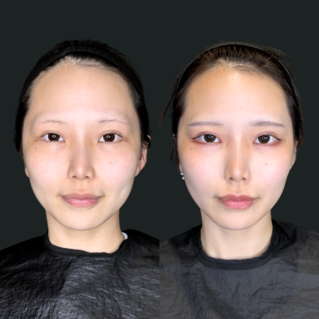 糸リフトの症例(ビフォーアフター)|大阪・豊中 Wing clinic