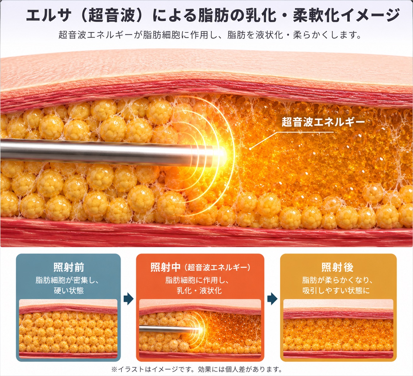 エルサ併用の施術イメージ
