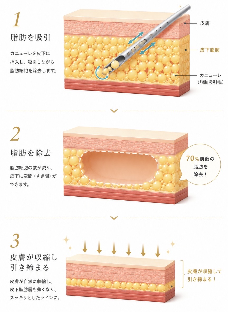 顔の脂肪吸引の仕組み — 極細カニューレで脂肪層ごとに吸引するイメージ