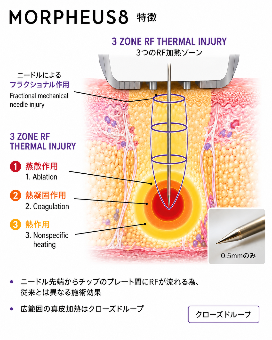 モフィウス8の3つのRF加熱ゾーン（蒸散・熱凝固・熱作用）図解