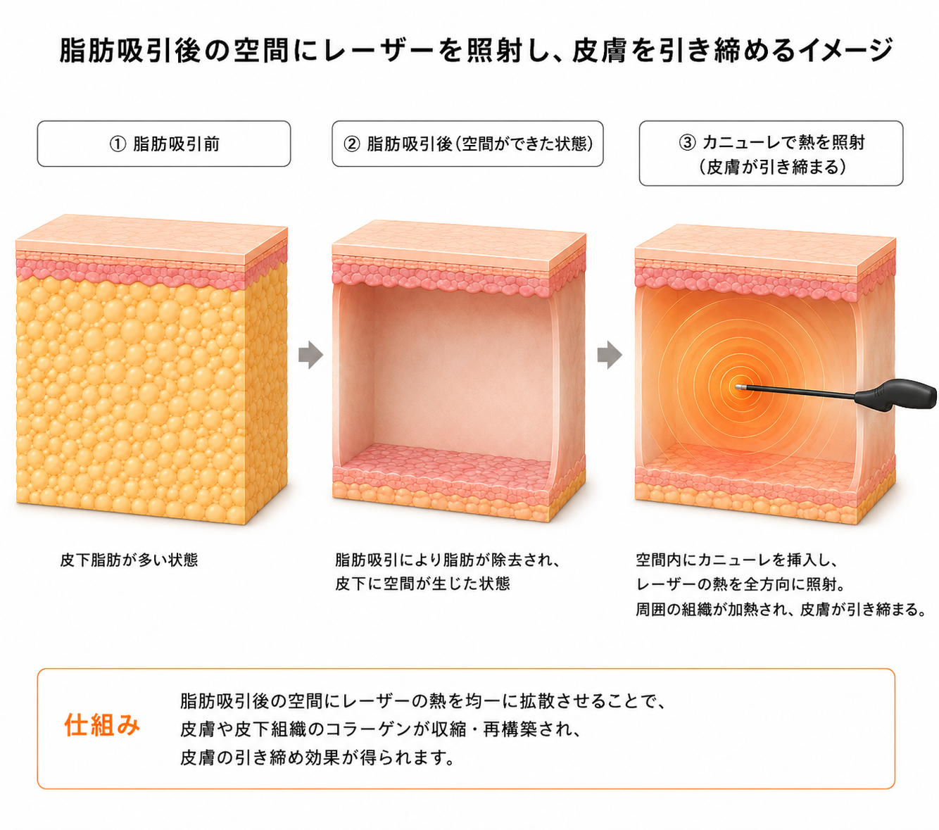 脂肪吸引後の空間にクォンタムRFを照射して皮膚を引き締める仕組み — 脂肪除去から熱照射までの流れ|大阪・豊中 Wing clinic
