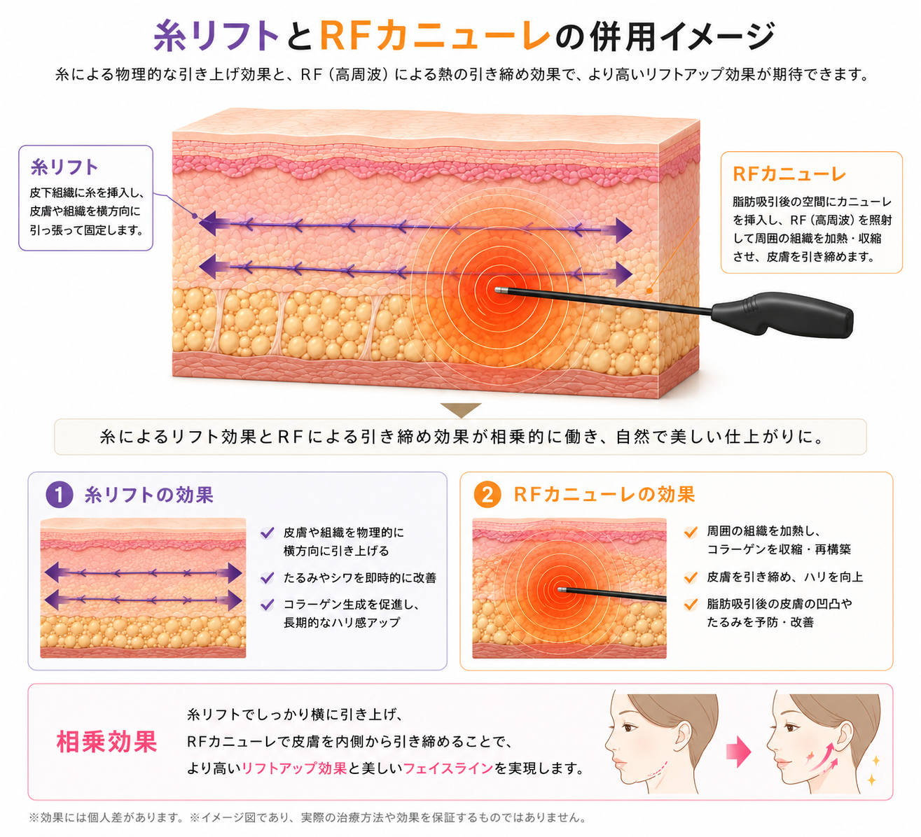 糸リフトとクォンタムRFカニューレの併用イメージ — 糸の引き上げとRFの引き締めの相乗効果でリフトアップ|大阪・豊中 Wing clinic