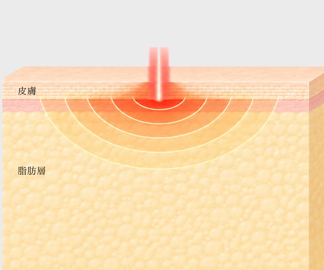 従来のRF・レーザー — 皮膚表面から熱を届けるため深部では減衰する仕組み｜大阪・豊中 Wing clinic