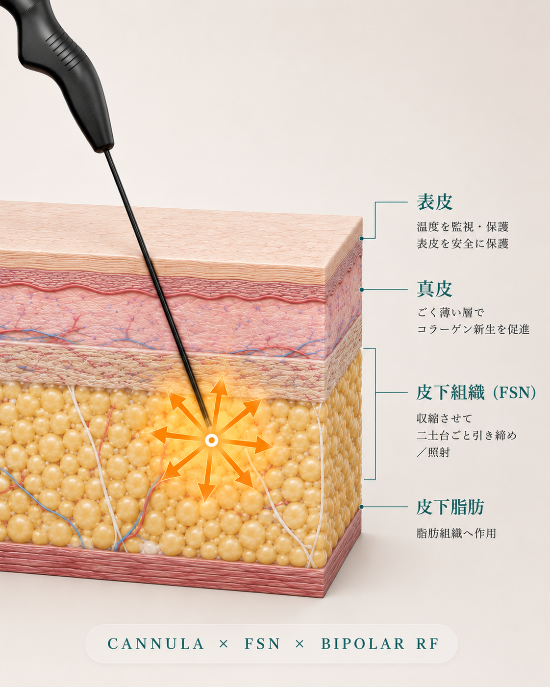 クォンタムRF（イグナイトRF）の仕組み — 極細カニューレを皮下に挿入し、皮膚の裏側から表皮・真皮・皮下組織（FSN）・皮下脂肪へバイポーラ高周波を照射する断面図｜大阪・豊中 Wing clinic